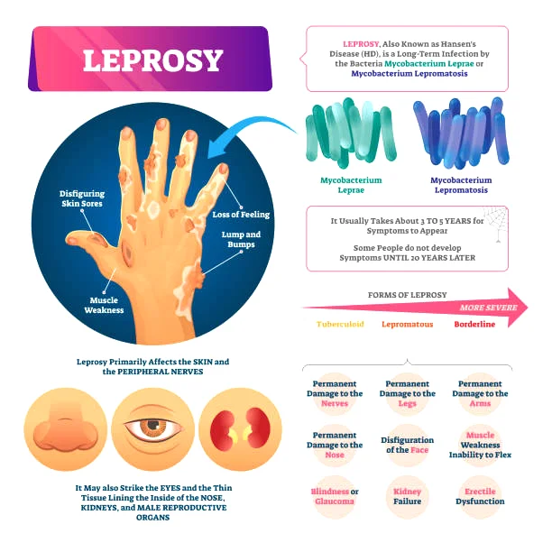 National Leprosy Day